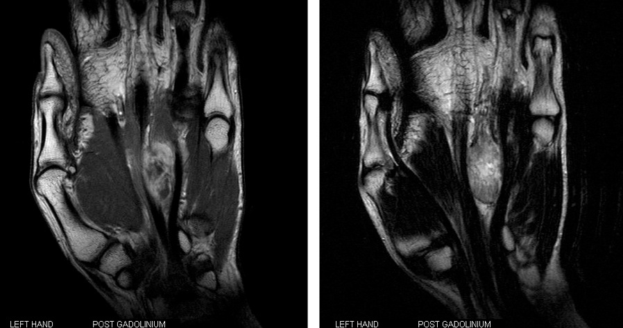 Figure 2 for case Nodular Faciitis